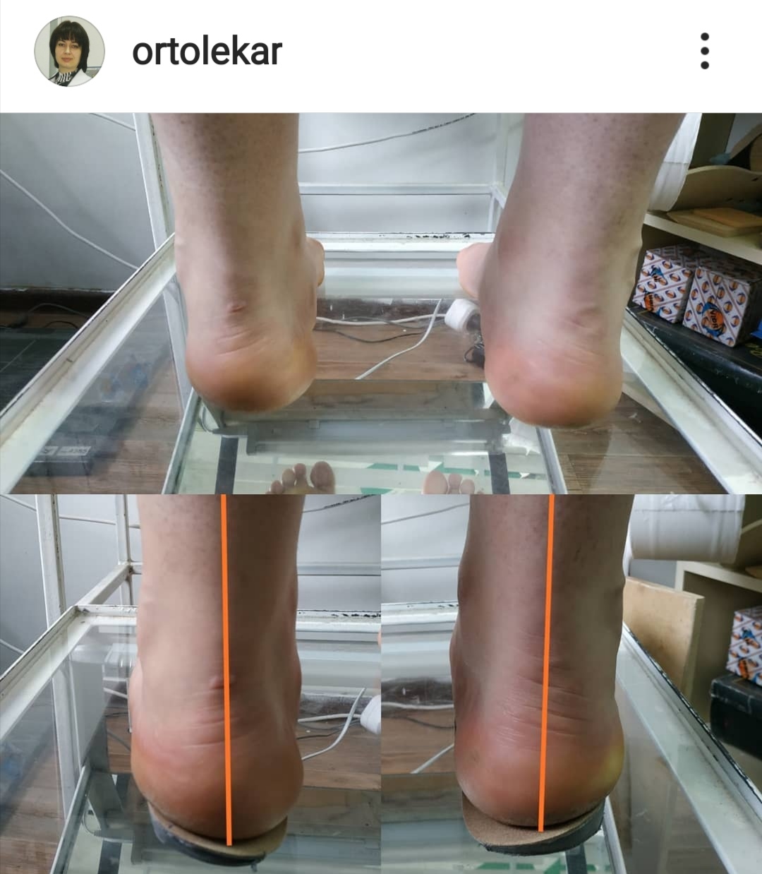 Когда помогают стельки ОртоЛекарь