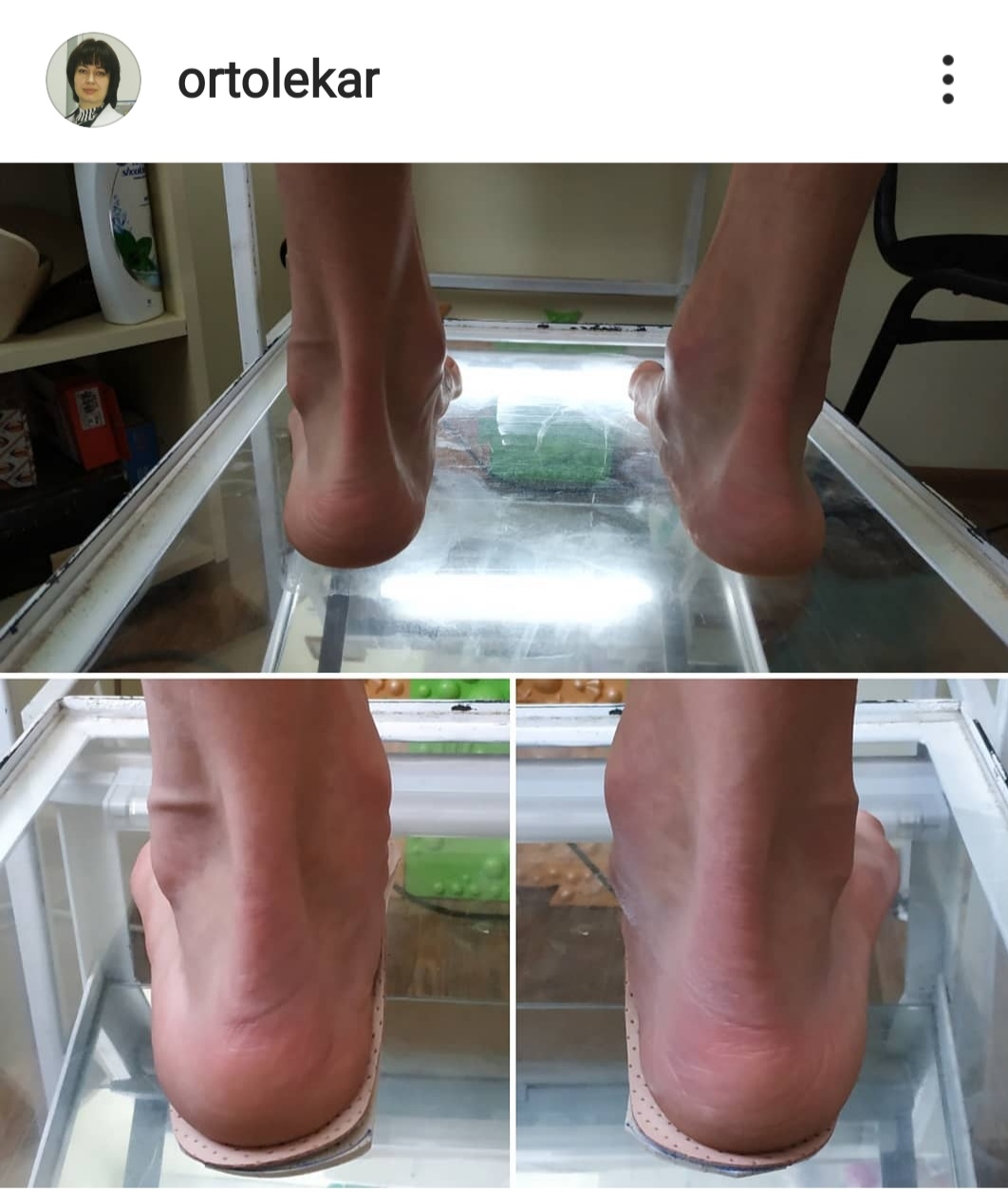 Когда помогают стельки ОртоЛекарь