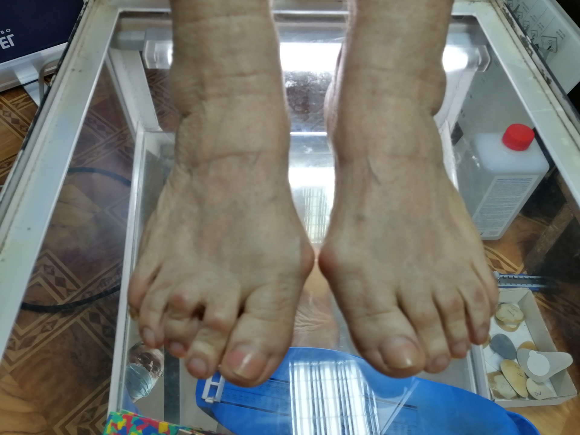 Когда помогают стельки ОртоЛекарь