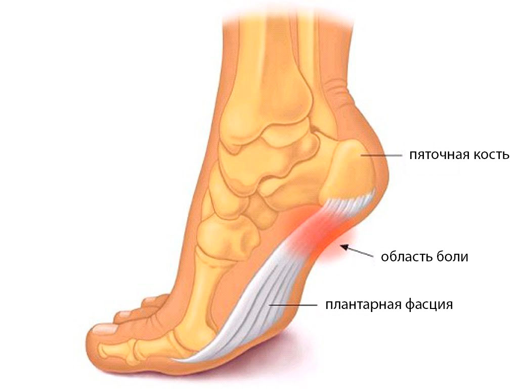Пяточная шпора Белгород