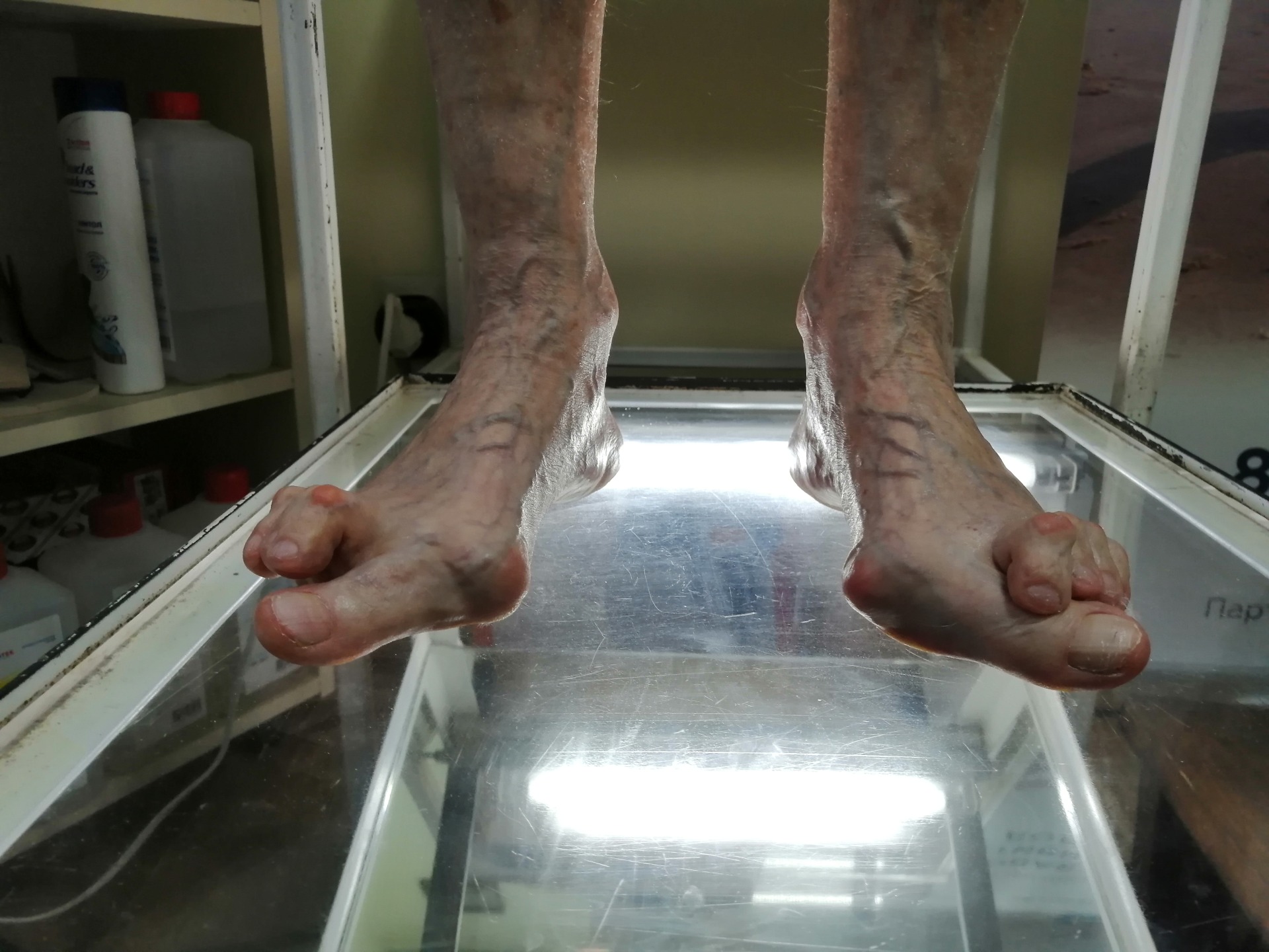 Когда помогают стельки ОртоЛекарь