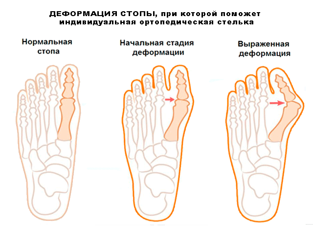 Вальгусное отклонение большого ипальца