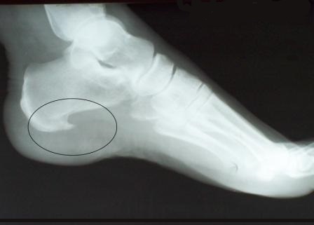 Пяточная шпора Белгород