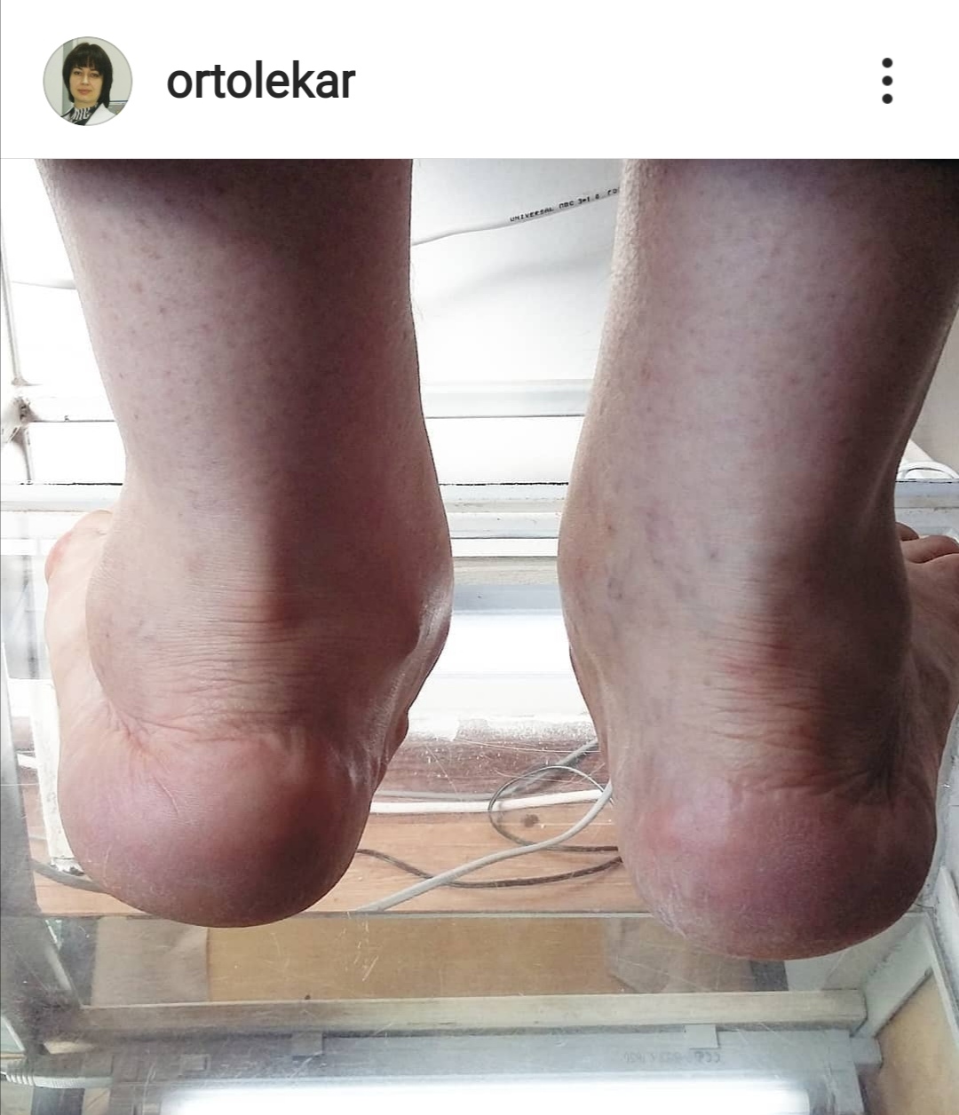 Когда помогают стельки ОртоЛекарь