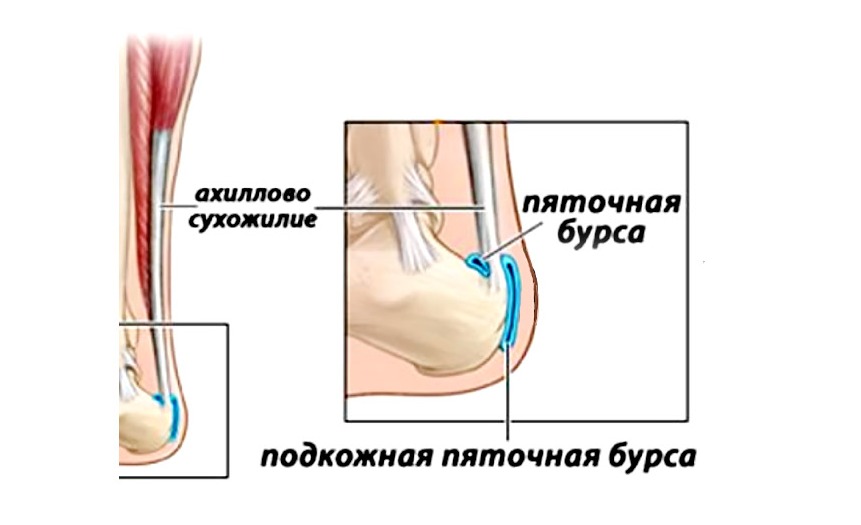Боли в области пятки